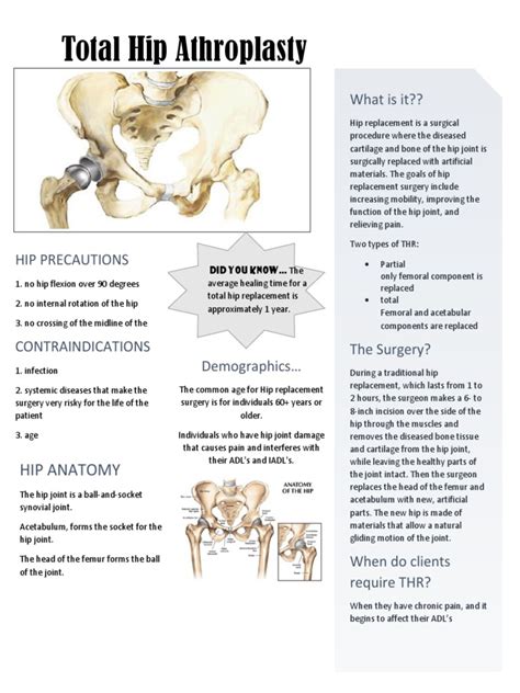 Total Hip Replacement Handout.